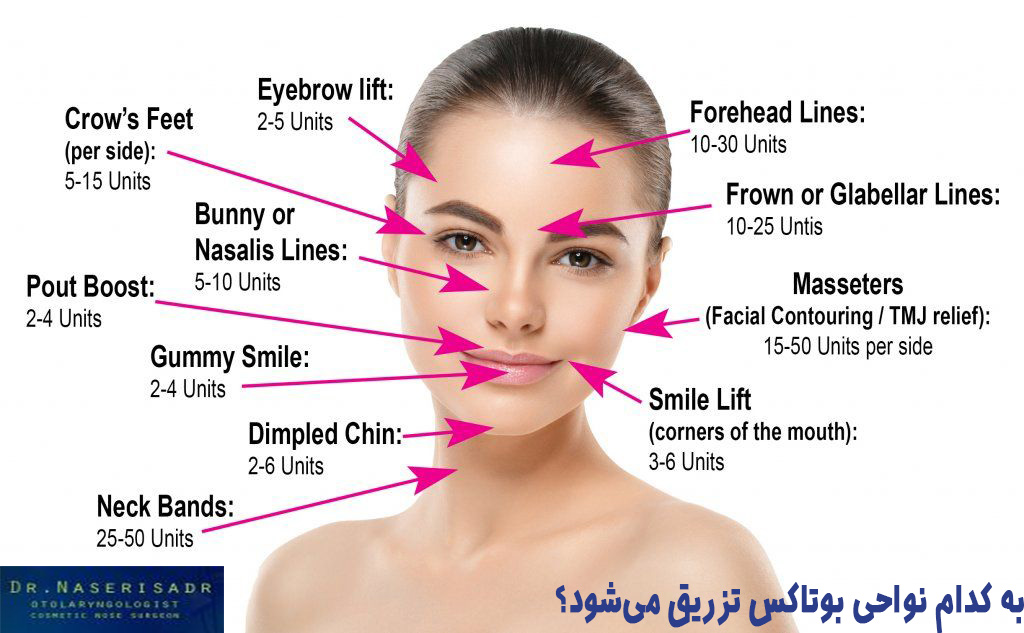 نواحی مناسب برای تزریق بوتاکس