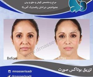 تزریق بوتاکس در مشهد
