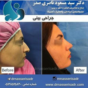 جراحی بینی