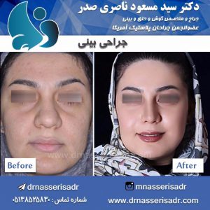 جراحی بینی گوشتی