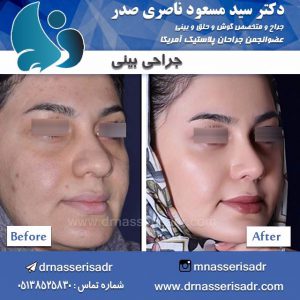 جراحی زیبایی بینی طبیعی