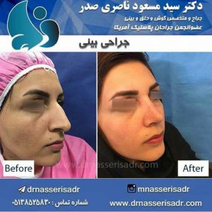 جراحی بینی