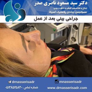 جراحی بینی طبیعی