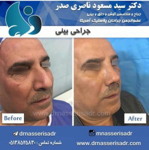 جراحی بینی در سنین بالا