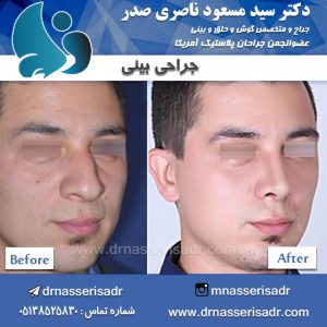 جراحی بینی