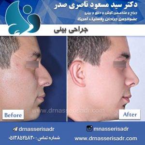 جراحی بینی