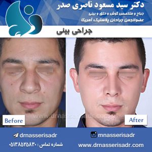 جراحی بینی