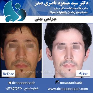 جراحی بینی