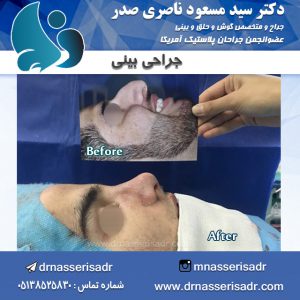 جراحی بینی