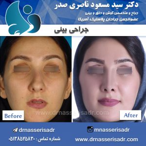 تاثیر فرم بینی در جراحی بینی