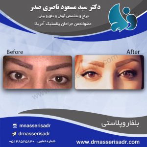 بلفاروپلاستی توسط دکتر ناصری صدر