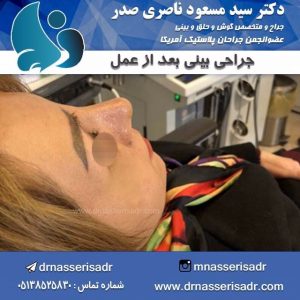 نمونه جراحی بینی دکتر مسعود ناصری صدر