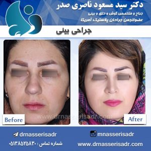 نمونه جراحی بینی گوشتی