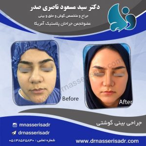 نمونه جراحی بینی گوشتی توسط دکتر مسعود ناصری صدر
