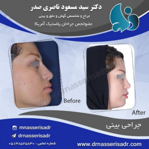 نمونه جراحی بینی زنانه