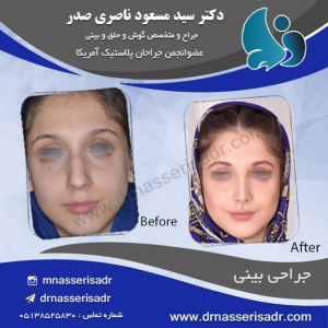 جراحی بینی زنانه و استخوانی