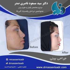 رینوپلاستی از نیم رخ راست حانم جوان