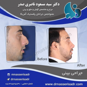 نمونه جراحی بینی توسط دکتر مسعود ناصری صدر