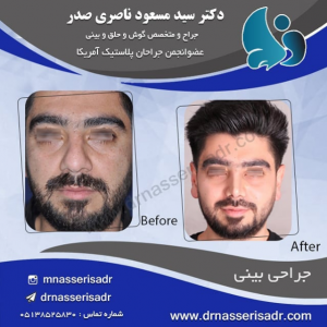 نمونه جراحی بینی توسط دکتر مسعود ناصری صدر