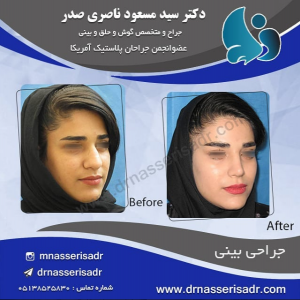 جراحی قبل و بعد بینی زنانه