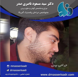 نمونه جراحی بینی توسط دکتر مسعود ناصری صدر