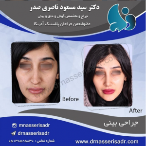 جراحی بینی زنانه