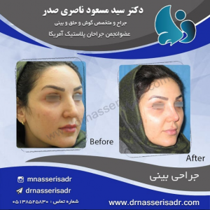 جراحی بینی زنانه