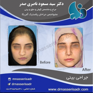 جراحی بینی کج و دفرمه