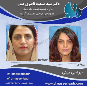 جراحی بینی زنانه