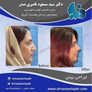 جراحی بینی زنانه