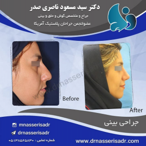 جراحی بینی استخوانی از نیم رخ راست
