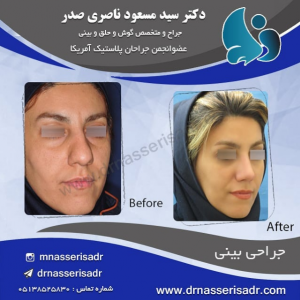 جراحی بینی زنانه