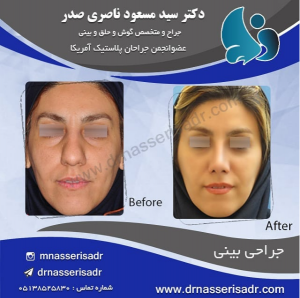 جراحی بینی زنانه