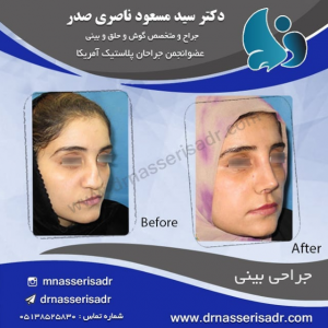 بینی گوشتی و پهن و نتیجه آن بعد از عمل