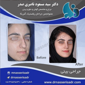 کوچک کردن بینی با عمل جراحی