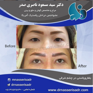 بلفاروپلاستی توسط دکتر مسعود ناصری صدر