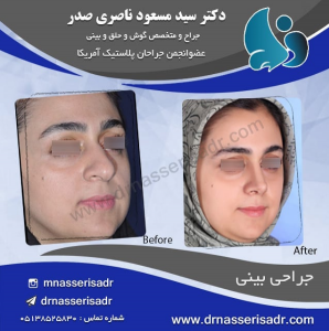بینی استخوانی و بزرگ و نتیجه آن بعد از عمل