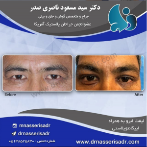 جراحی افتادگی پلک در مرد مسن در مشهد