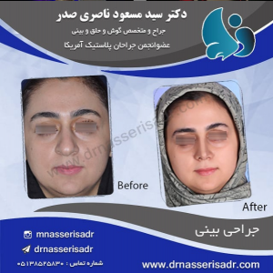 جراحی بینی بزرگ و گوشتی توسط دکتر ناصری صدر