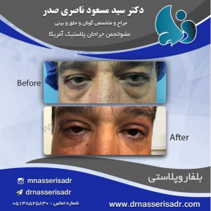 بلفاروپلاستی آقای مسن توسط دکتر مسعود ناصری صدر
