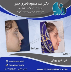 جراحی بینی زنانه از نیم رخ راست