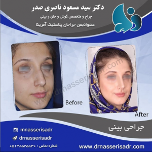 نمونه جراحی بینی توسط دکتر مسعود ناصری صدر