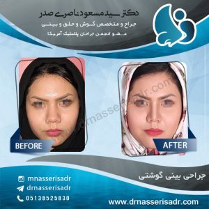 عمل بینی گوشتی توسط دکتر ناصری صدر