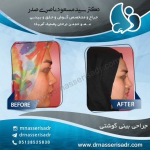 بینی گوشتی قبل و بعد جراحی در مشهد