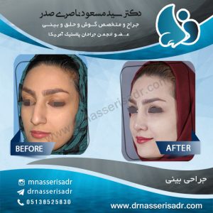 عمل بینی استخوانی توسط دکتر ناصری صدر