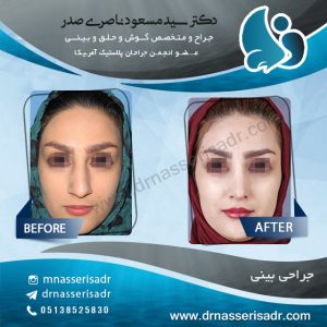 عمل بینی توسط دکتر ناصری صدر