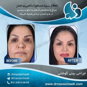 جراحی کوچک کردن پره های بینی