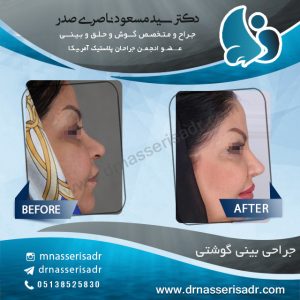 نمونه جراحی بینی زنانه و گوشتی توسط دکتر ناصری صدر