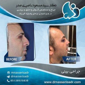 جراحی بینی