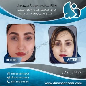 عمل بینی طبیعی زنانه از تمام رخ توسط دکتر ناصری صدر